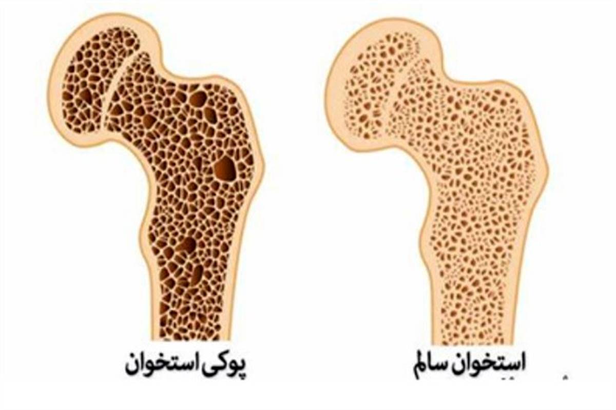 شکستگی ناشی از پوکی استخوان در زنان ۴ برابر مردان است