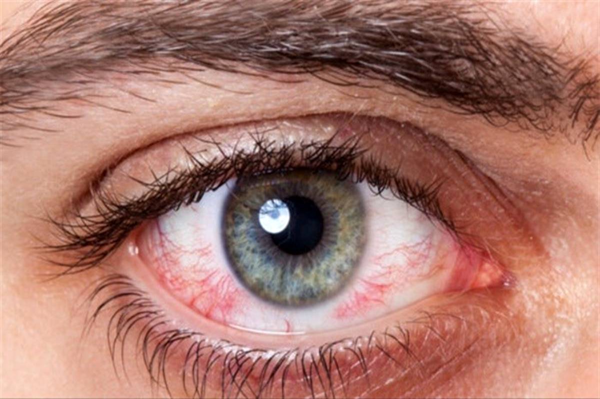 به تعویق انداختن درمان کدام یک از بیماری‌های چشمی خطرناک است؟