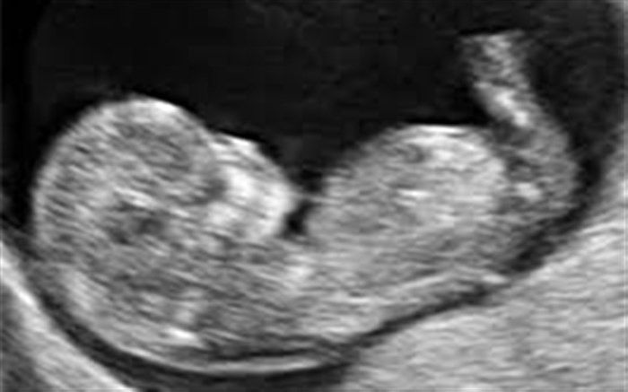 سقط جنین تنها قبل از چهار ماهگی انجام می‌شود