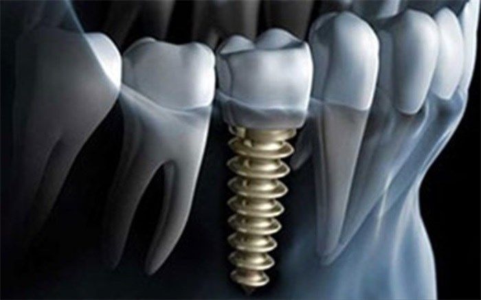 بهره‌برداری از طرح تولید ملی ایمپلنت دندانی با حمایت صندوق نوآوری و شکوفایی