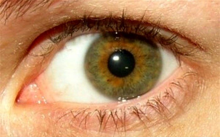 امکان التهاب چشم در تهاجم کووید ۱۹ وجود دارد