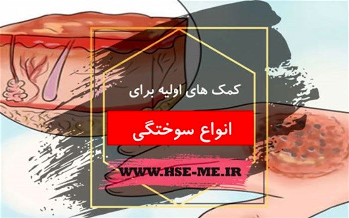 کمک‌های اولیه برای مصدوم دچار سوختگی+اینفوگرافیک