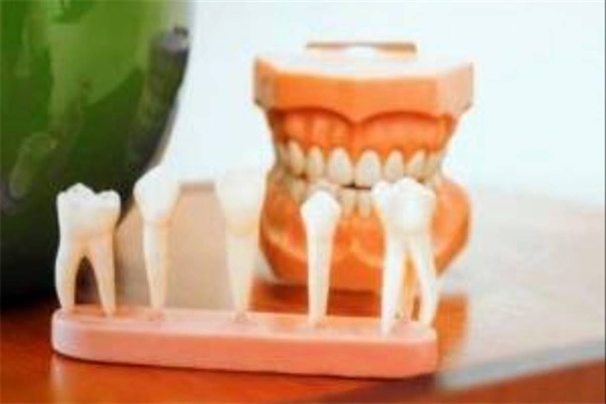 اشتباهی که نباید بعد کشیدن دندان عقل مرتکب شوید