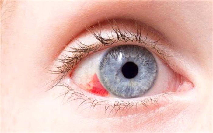 علت وجود لکه‌های قرمز داخل چشم