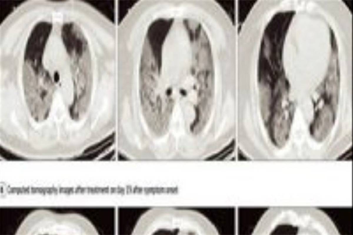 بیماران کرونایی چه زمانی باید «سی تی اسکن»دهند؟