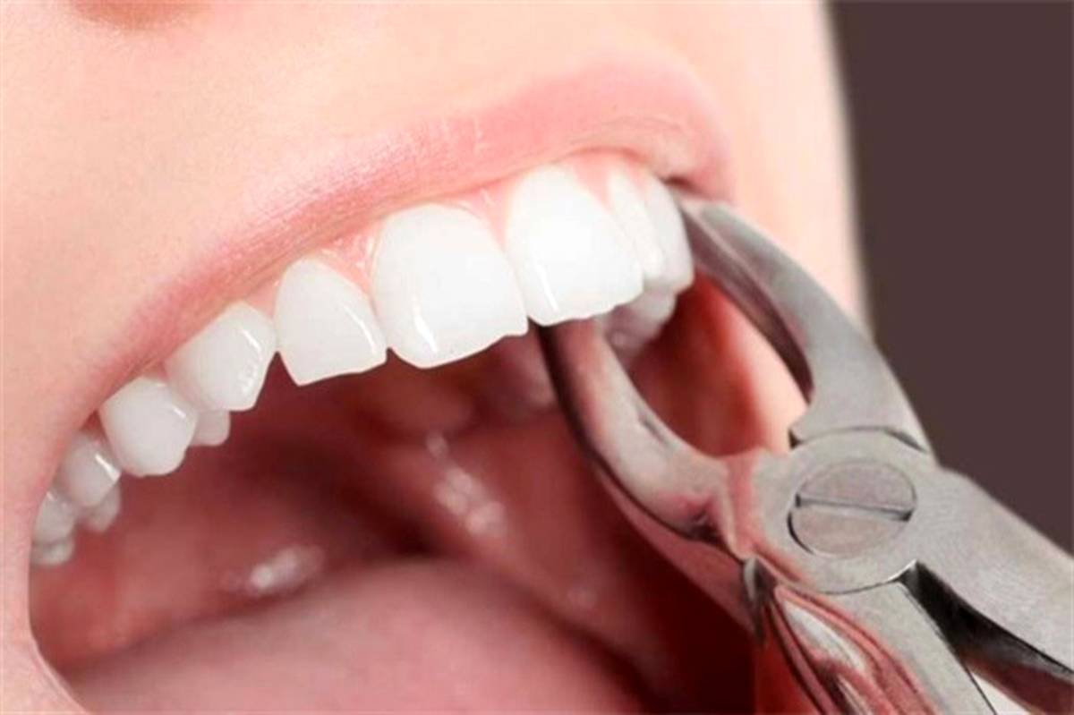 مراقبت‌های غذایی پس از کشیدن دندان عقل
