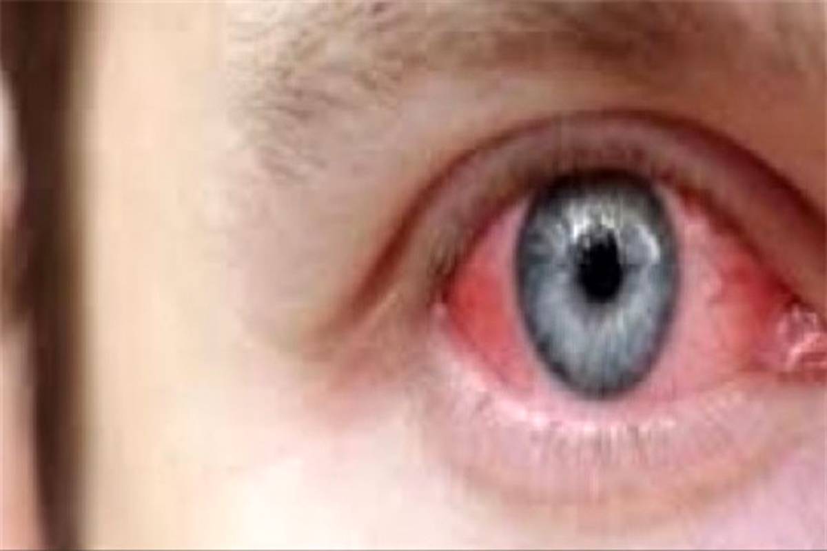 تشخیص التهاب روماتیسمی مفاصل با علائم چشمی