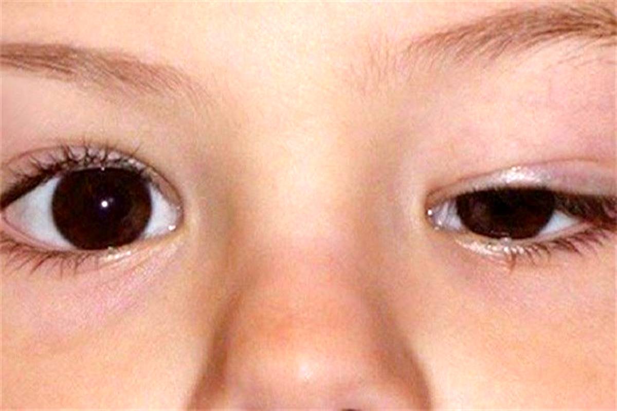 درمان افتادگی پلک‌ چشم+اینفوگرافیک