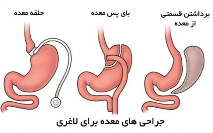 عمل‌های لاغری خوب یا بد؟/فیلم