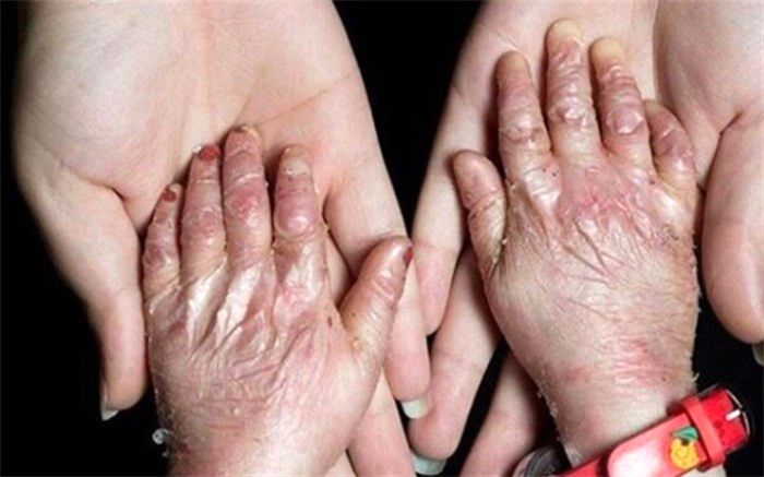روند صعودی مشکلات مبتلایان به بیماری‌های نادر؛ کمیته بیماری‌های نادر در مجلس تشکیل شد