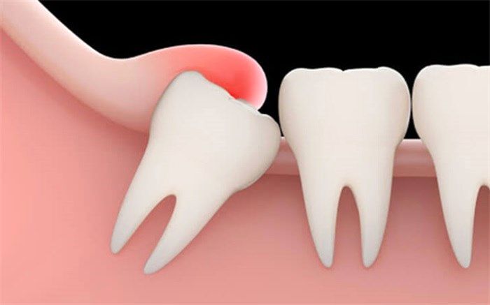 پس از کشیدن دندان عقل این نکات مهم را فراموش نکنید