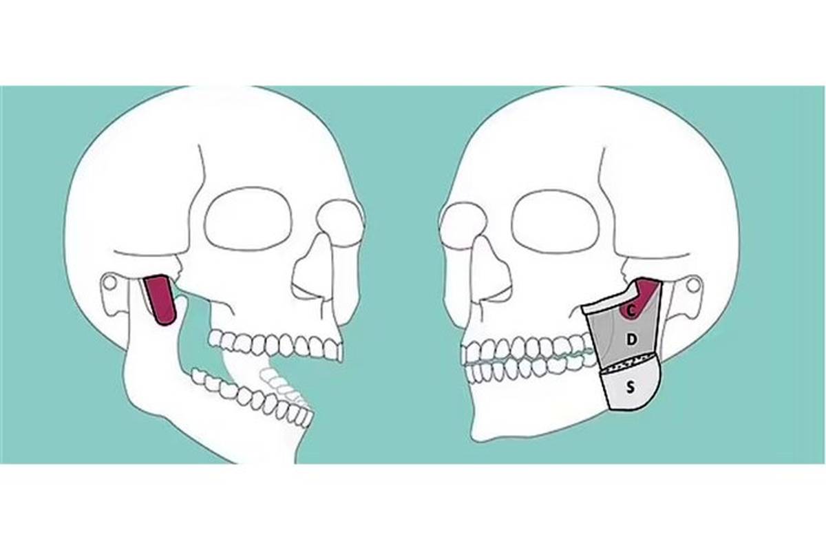 کشف لایه عضلانی جدیدی در فک پایین انسان