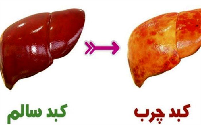 نکته‌هایی مهم درباره کبد چرب که باید دانست