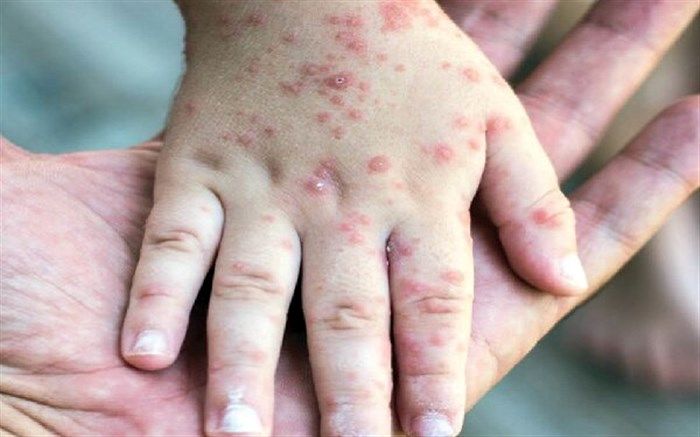 خطر ابتلای کودکان به بیماری سرخک در کهگیلویه و بویراحمد