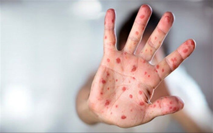 علائم سرخک و اهمیت واکسیناسیون کودکان