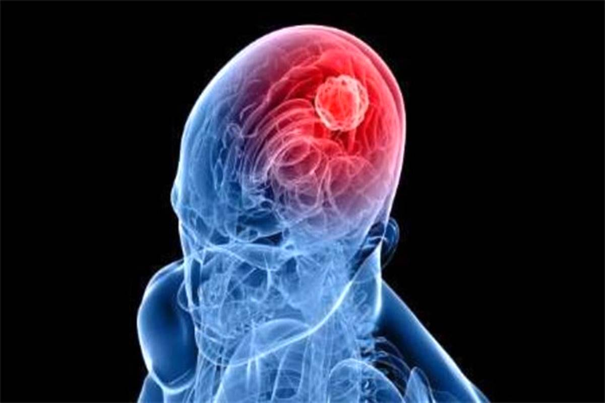 علائم و نشانه‌های هشداردهنده تومور مغزی چیست؟
