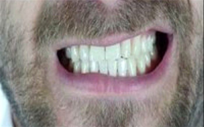 با این روش‌ها دندان قروچه را درمان کنید