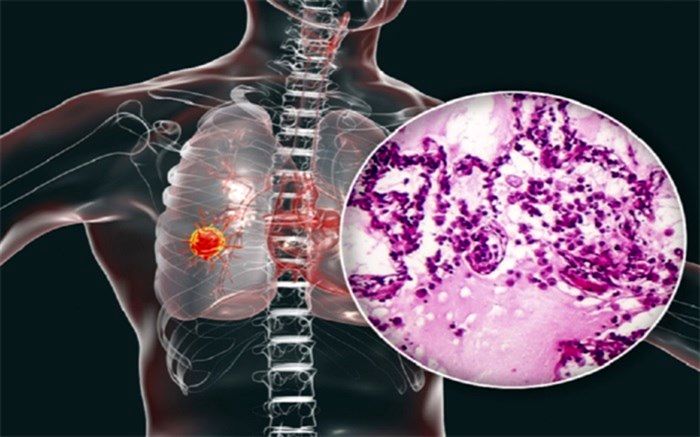 سرطان ریه شایع‌ترین و کشنده‌ترین تومور در بدن انسان