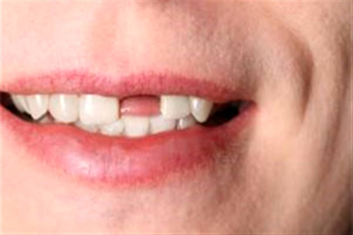 عوارض نداشتن دندان و فضای خالی بین دندان‌ها