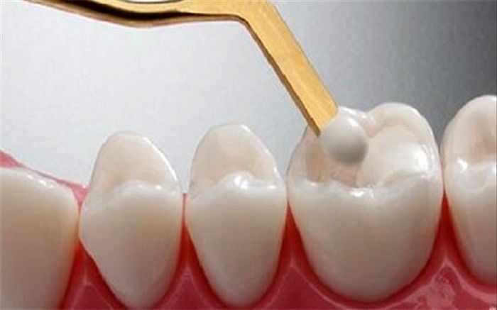 چه زمان‌هایی باید جرم‌گیری دندان را انجام دهیم؟