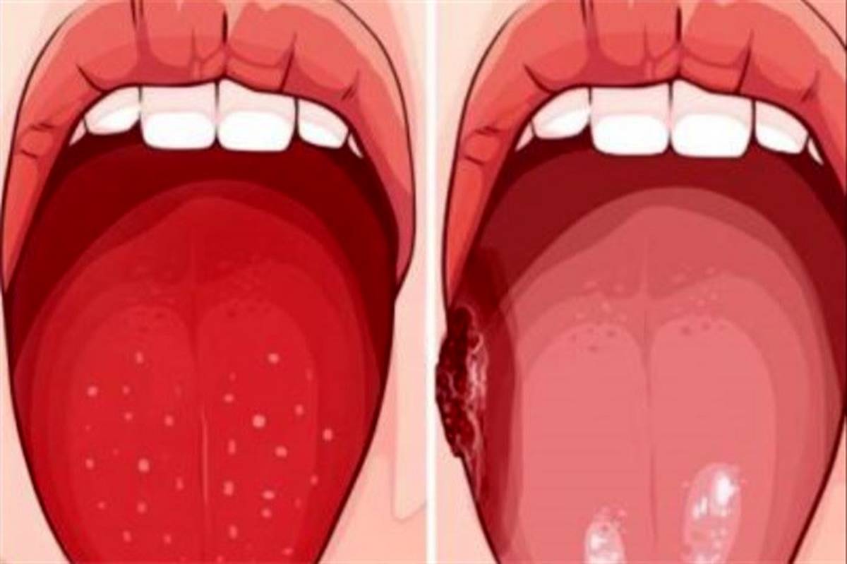 راه‌های درمان زخم روی زبان و دهان