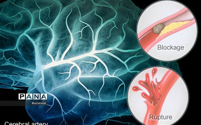 3 ساعت اول زمان طلایی در بهبود سکته‌های مغزی