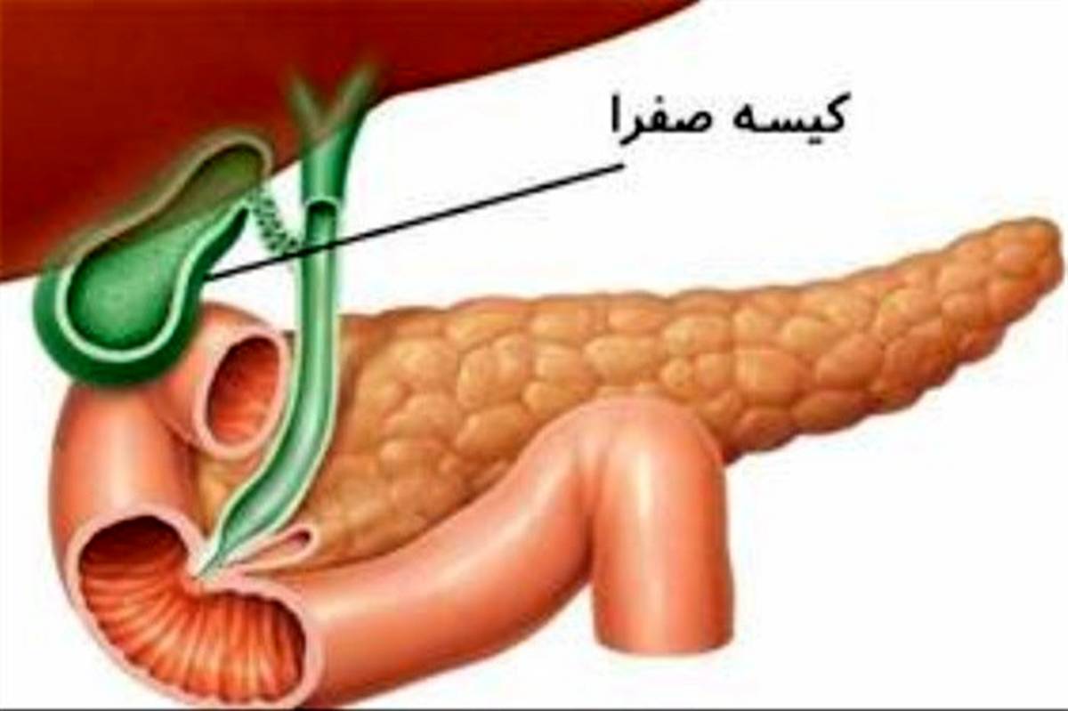 پیشگیری از مشکلات کیسه‌صفرا