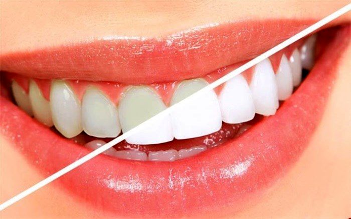 سفید کردن دندان‌ها  ،  با ٧ فرمول طبیعی دندان‌هایتان مثل مروارید می‌درخشد