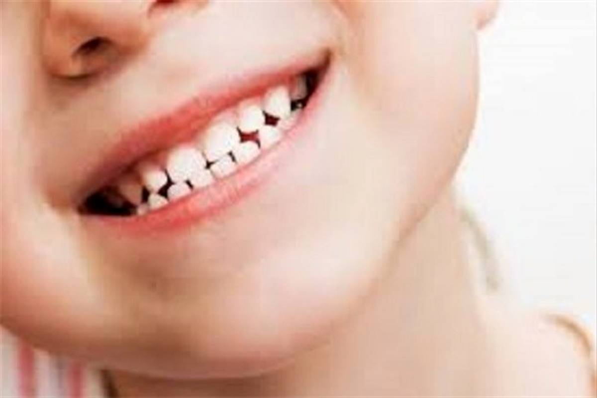 کشیدن دندان‌های شیری کودکان بدون توجیه مشکل‌ساز می‌شود