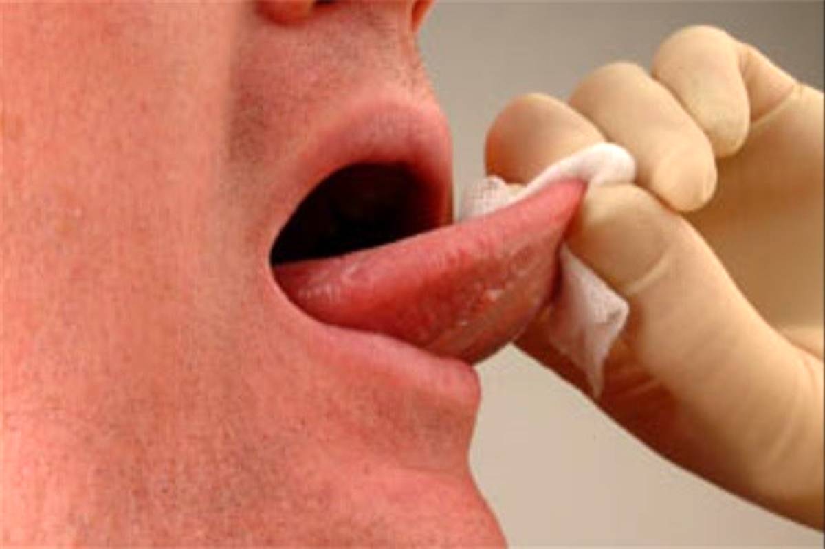 نشانه های سرطان زبان چیست؟
