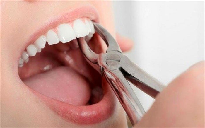 کشیدن دندان از نتایج بالا رفتن تعرفه‌های دندانپزشکی در خراسان شمالی