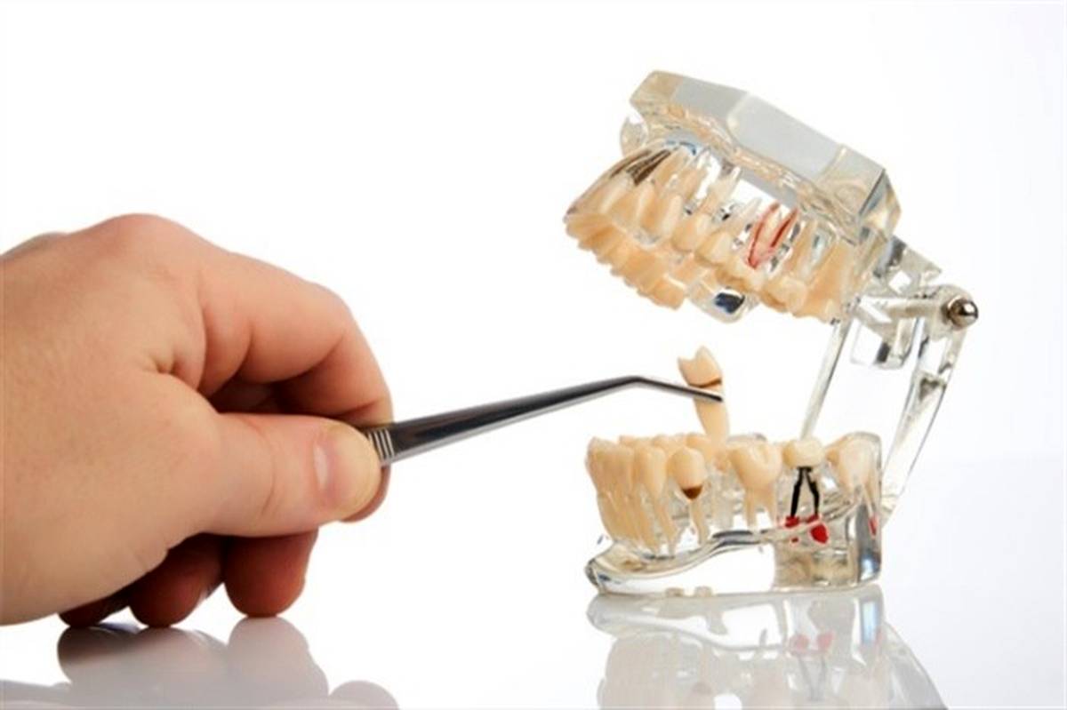 مراقبت‌های پس از کشیدن دندان