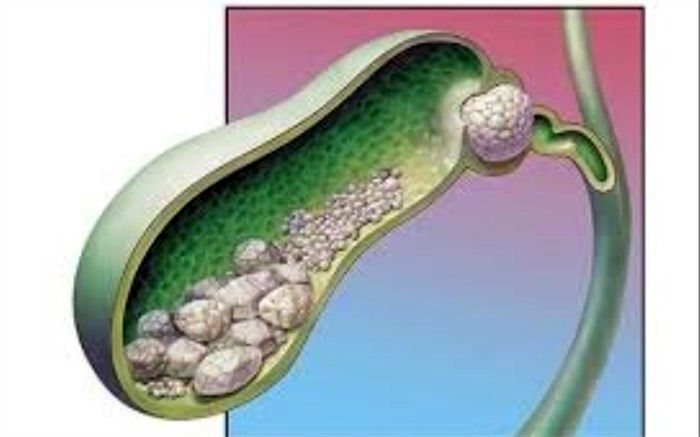 نوشیدن قهوه از سنگ کیسه صفرا پیشگیری می‌کند