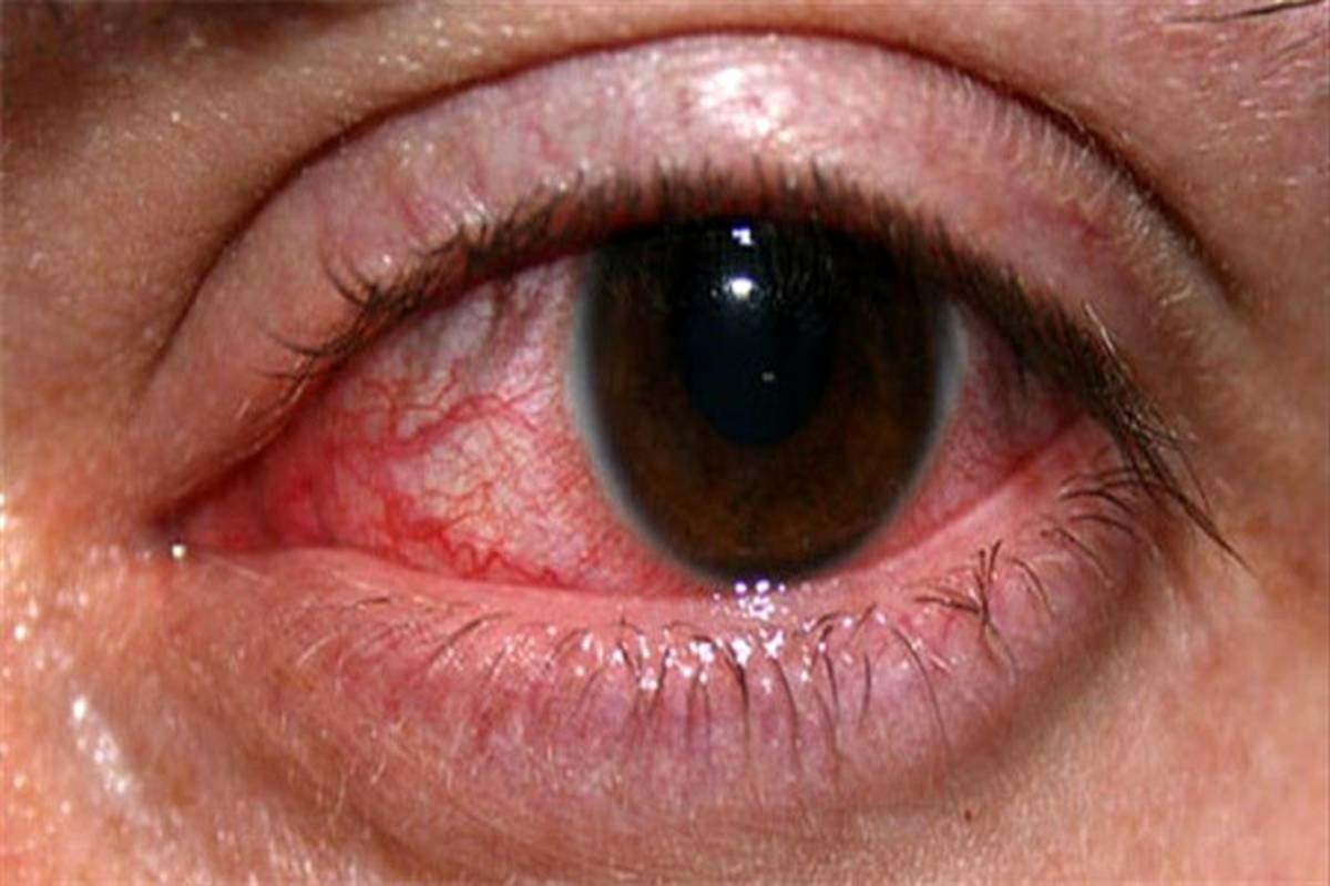 علائم خشکی چشم را بشناسید