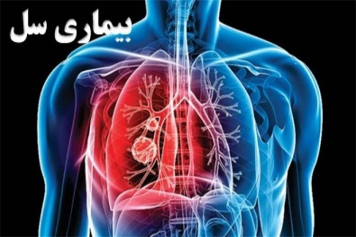 نگاهی به آمار بیماری سل در ایران+اینفوگرافی