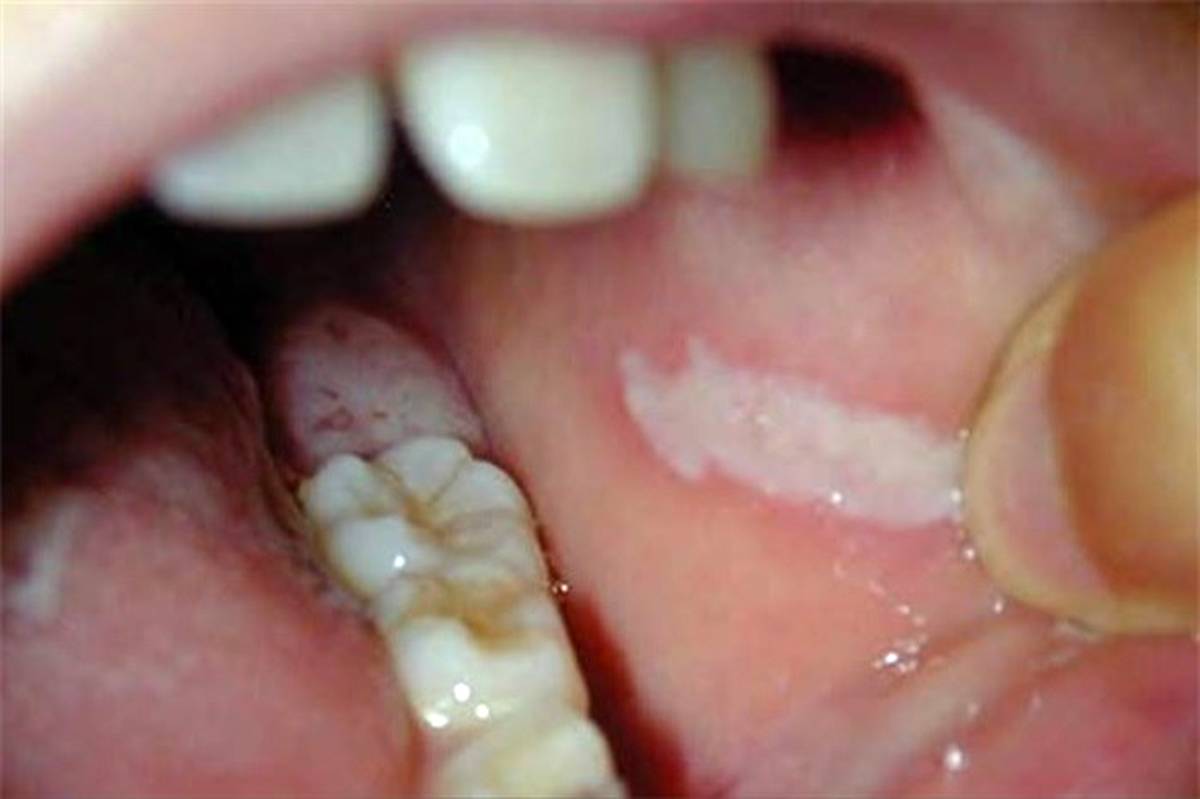 عدم رویش دندان «عقل» باعث تبدیل کیست‌های لثه به تومور می‌شود