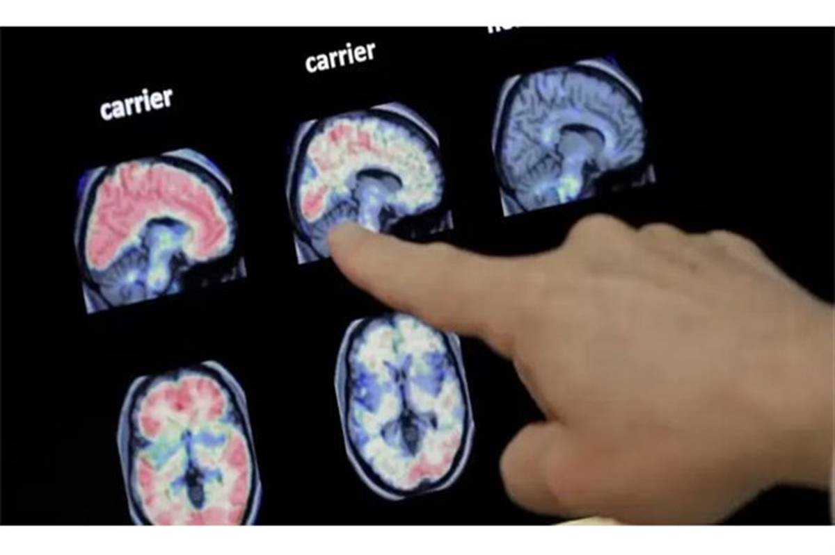 تشخیص زودهنگام آلزایمر با نشانگر عصبی جدید